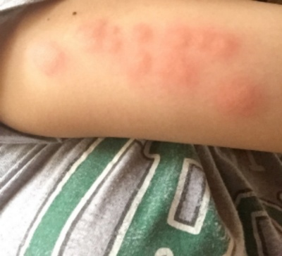 Bed bug bites Bed Bug Bites Pest Control Service in the Chicago and Rockford DMA