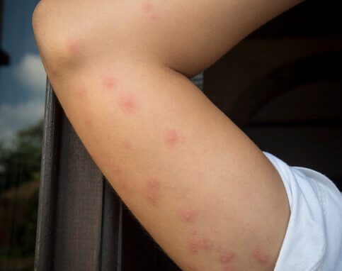 A boy showing the bed bug bites in his arms in Chicago and Rockford, DMA